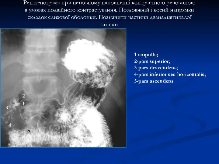 Рентгенограма при неповному наповненні контрастною речовиною в умовах подвійного контрастування.