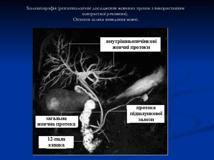 Холангіографія (рентгенологічне дослідження жовчних проток з використанням контрастної речовини). Описати шляхи виведення жовчі.