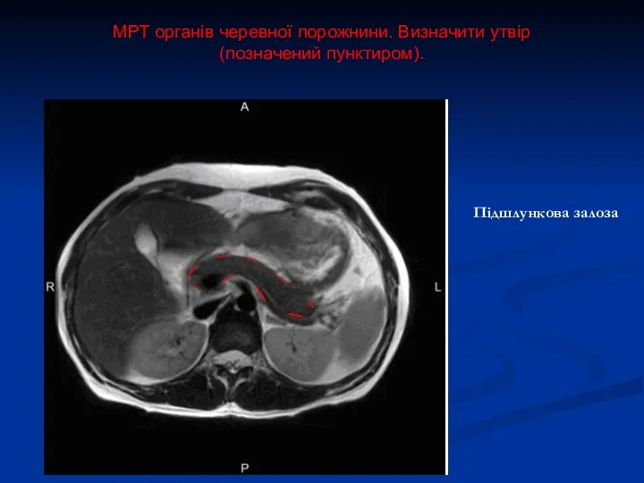 МРТ органів черевної порожнини. Визначити утвір (позначений пунктиром). Підшлункова залоза