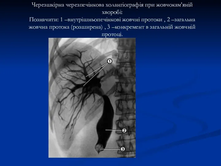 Черезшкірна черезпечінкова холангіографія при жовчокам’яній хворобі: Позначити: 1 –внутрішньопечінкові жовчні