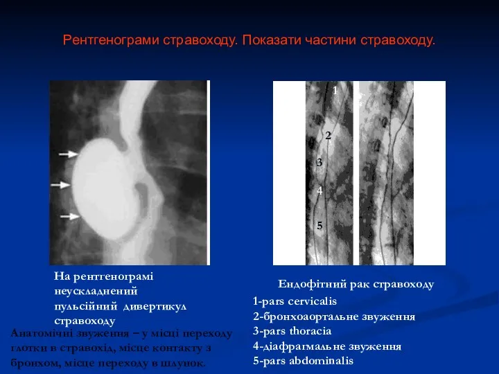 Рентгенограми стравоходу. Показати частини стравоходу. На рентгенограмі неускладнений пульсійний дивертикул