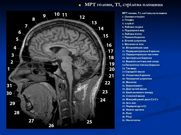 МРТ голови, Т1, стрілова площина МРТ голови, Т1, сагітальна площина