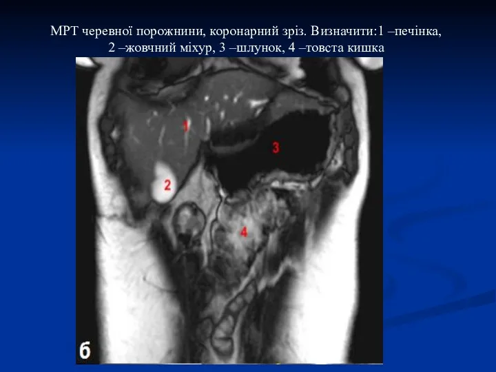 МРТ черевної порожнини, коронарний зріз. Визначити:1 –печінка, 2 –жовчний міхур, 3 –шлунок, 4 –товста кишка