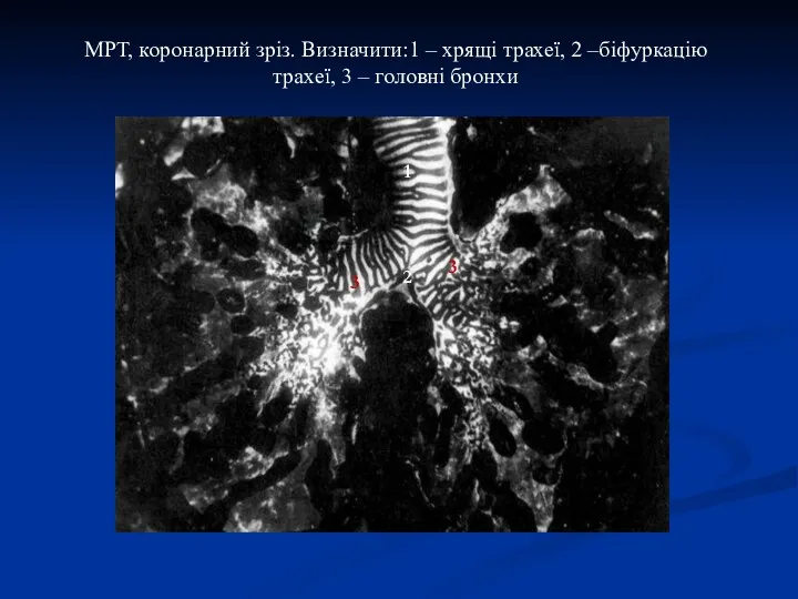 МРТ, коронарний зріз. Визначити:1 – хрящі трахеї, 2 –біфуркацію трахеї,