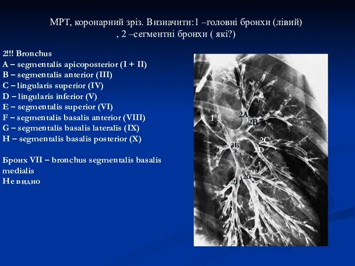 МРТ, коронарний зріз. Визначити:1 –головні бронхи (лівий) , 2 –сегментні