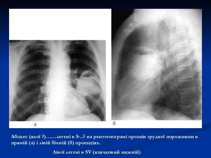 Абсцес (якої ?)……легені в S-..? на рентгенограмі органів грудної порожнини