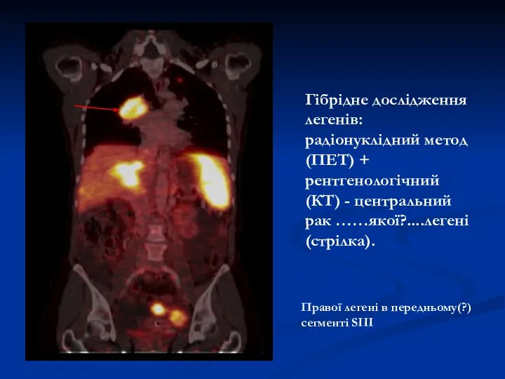 Гібрідне дослідження легенів: радіонуклідний метод (ПЕТ) + рентгенологічний (КT) -