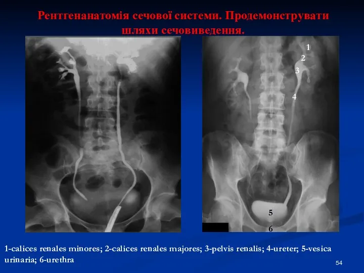 Рентгенанатомія сечової системи. Продемонструвати шляхи сечовиведення. 1-calices renales minores; 2-calices