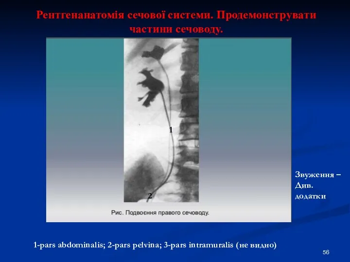 Рентгенанатомія сечової системи. Продемонструвати частини сечоводу. 1-pars abdominalis; 2-pars pelvina;