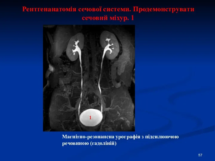 Рентгенанатомія сечової системи. Продемонструвати сечовий міхур. 1 Магнітно-резонансна урографія з підсилюючою речовиною (гадоліній) 1