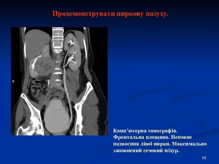 Продемонструвати ниркову пазуху. Комп’ютерна томографія. Фронтальна площина. Неповне подвоєння лівої нирки. Максимально заповнений сечовий міхур.