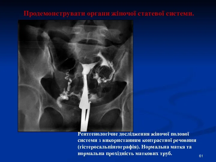 Продемонструвати органи жіночої статевої системи. Рентгенологічне дослідження жіночої полової системи