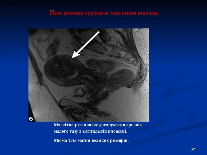 Продемонструвати частини матки. Магнітно-резонансне дослідження органів малого тазу в сагітальній площині. Міома тіла матки великих розмірів.