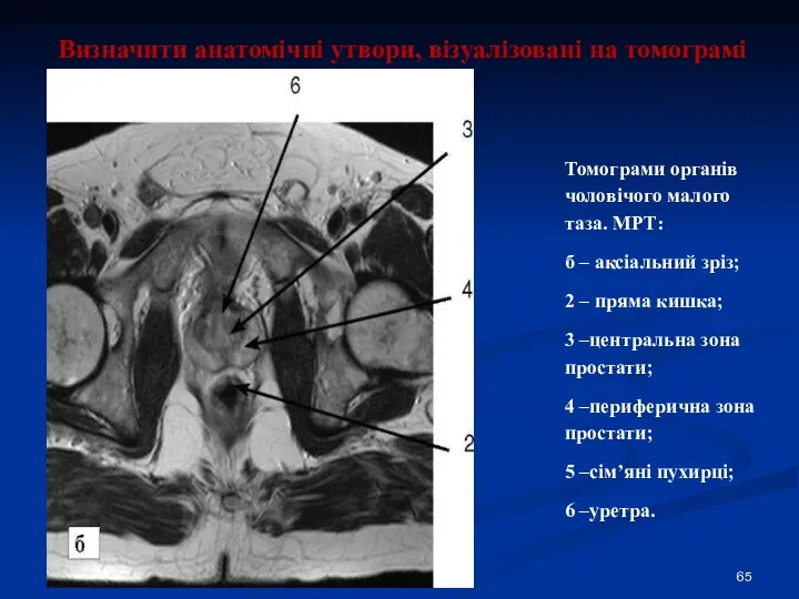 Визначити анатомічні утвори, візуалізовані на томограмі Томограми органів чоловічого малого