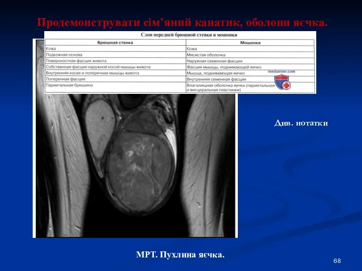 Продемонструвати сім’яний канатик, оболони яєчка. МРТ. Пухлина яєчка. Див. нотатки