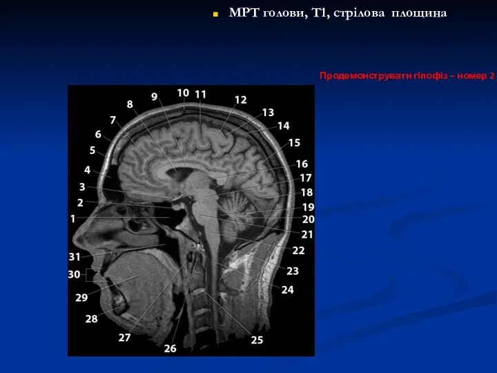 МРТ голови, Т1, стрілова площина Продемонструвати гіпофіз – номер 2