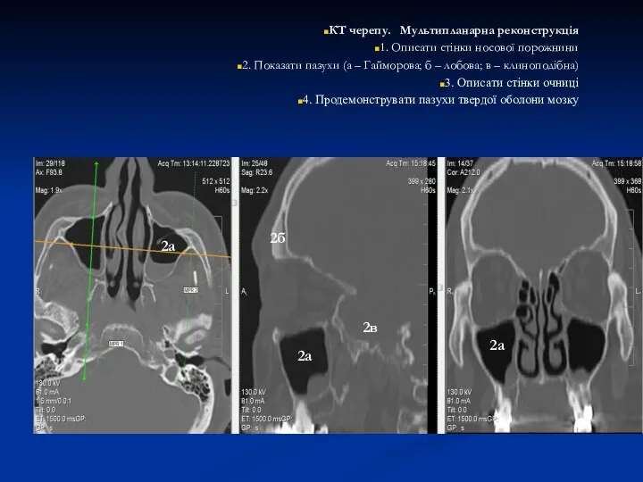 КТ черепу. Мультипланарна реконструкція 1. Описати стінки носової порожнини 2.