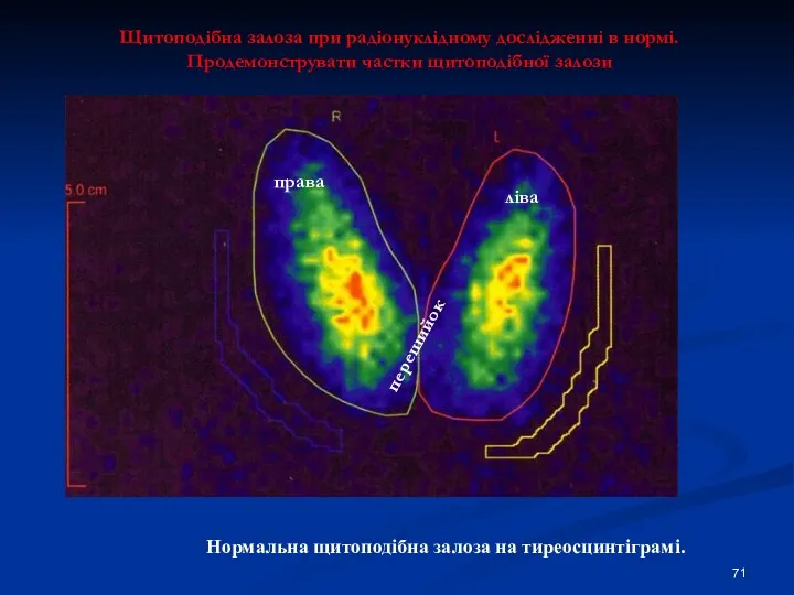 Щитоподібна залоза при радіонуклідному дослідженні в нормі. Продемонструвати частки щитоподібної