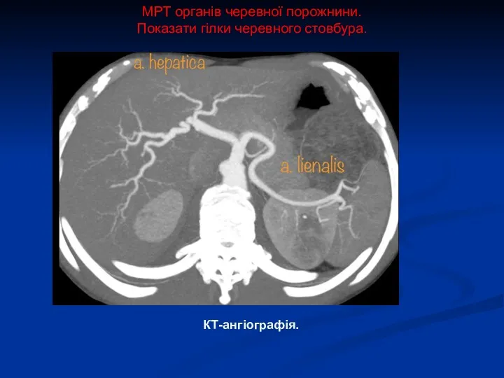 МРТ органів черевної порожнини. Показати гілки черевного стовбура. КТ-ангіографія.