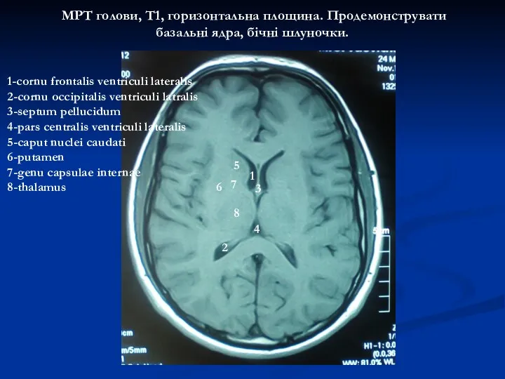МРТ голови, Т1, горизонтальна площина. Продемонструвати базальні ядра, бічні шлуночки.