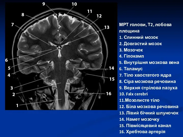 МРТ голови, Т2, лобова площина 1. Спинний мозок 2. Довгастий