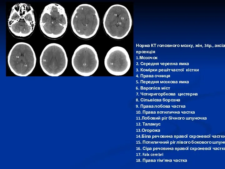 Норма КТ головного мозку, жін, 34р., аксіальна проекція 1.Мозочок 2.