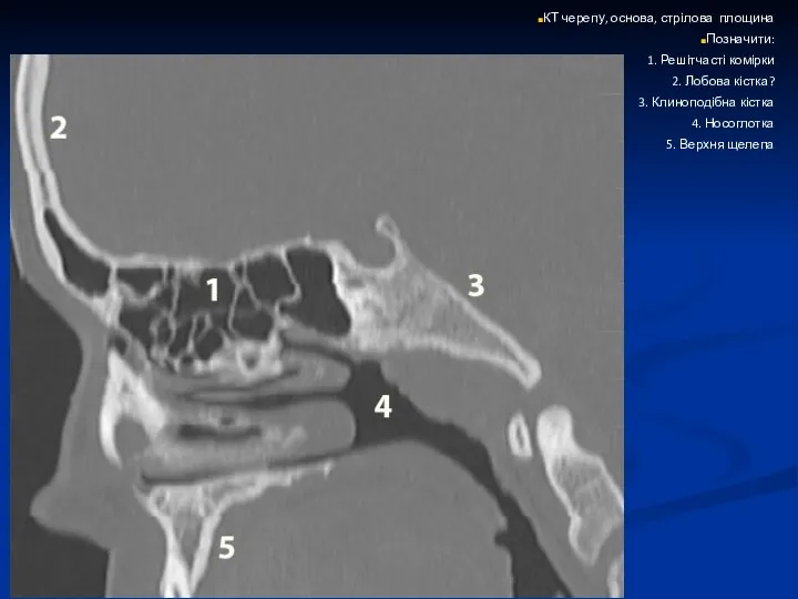 КТ черепу, основа, стрілова площина Позначити: 1. Решітчасті комірки 2.