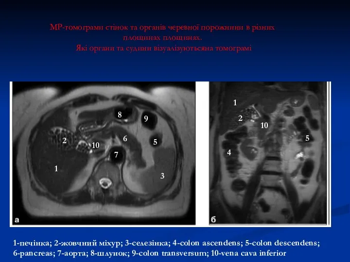 МР-томограми стінок та органів черевної порожнини в різних площинах площинах.