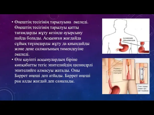 Өңештің тесігінің тарылуына əкеледі. Өңештің тесігінің тарылуы қатты тағамдарды жұту