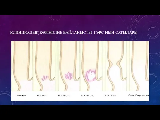 КЛИНИКАЛЫҚ КӨРІНІСІНЕ БАЙЛАНЫСТЫ ГЭРС-НЫҢ САТЫЛАРЫ