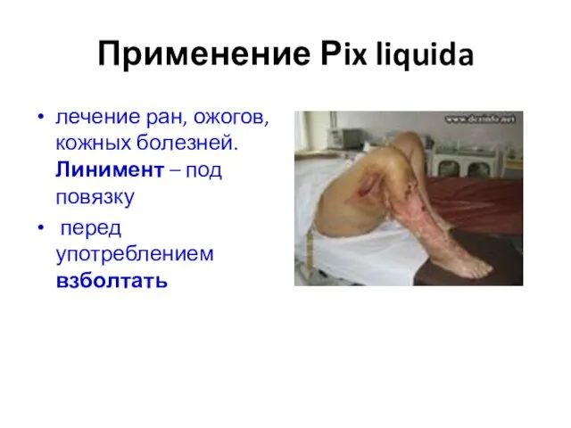 Применение Рix liquida лечение ран, ожогов, кожных болезней. Линимент – под повязку перед употреблением взболтать
