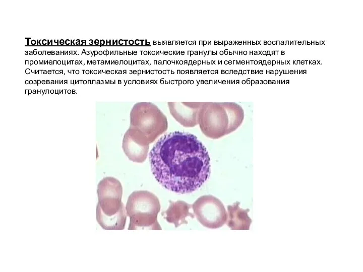 Токсическая зернистость выявляется при выраженных воспалительных заболеваниях. Азурофильные токсические гранулы