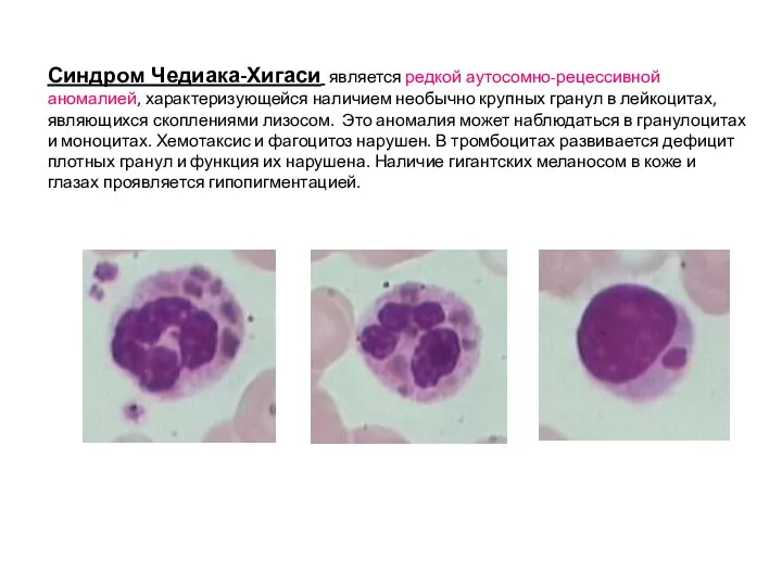 Синдром Чедиака-Хигаси является редкой аутосомно-рецессивной аномалией, характеризующейся наличием необычно крупных