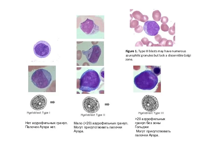 Figure 1. Type III blasts may have numerous azurophilic granules but lack a discernible Golgi zone.