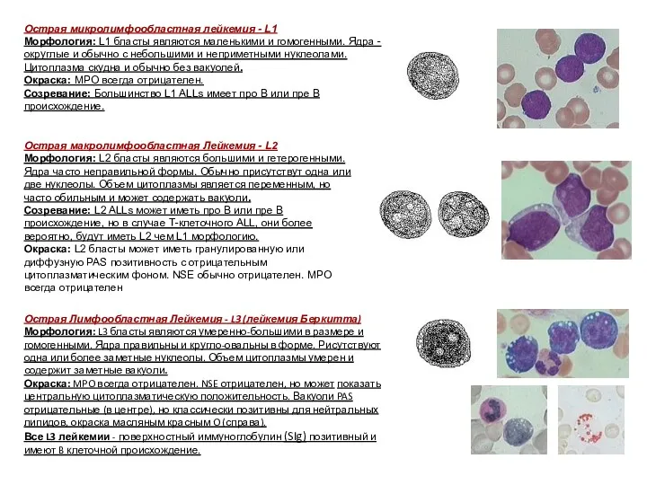 . Острая Лимфообластная Лейкемия - L3 (лейкемия Беркитта) Морфология: L3
