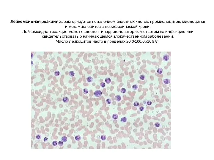 Лейкемоидная реакция характеризуется появлением бластных клеток, промиелоцитов, миелоцитов и метамиелоцитов