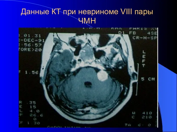 Данные КТ при невриноме VIII пары ЧМН