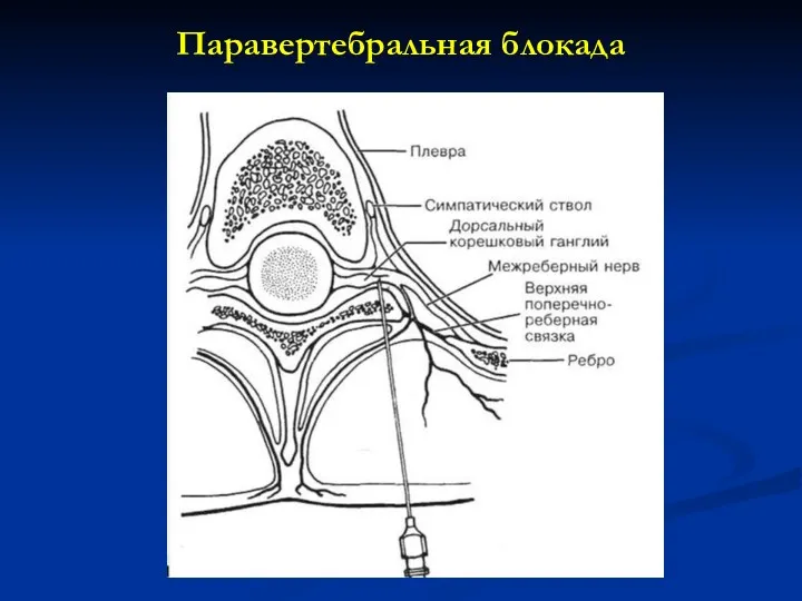 Паравертебральная блокада