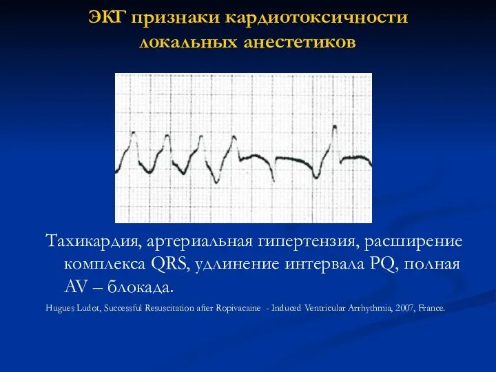 ЭКГ признаки кардиотоксичности локальных анестетиков Тахикардия, артериальная гипертензия, расширение комплекса