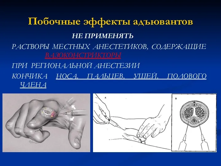 Побочные эффекты адъювантов НЕ ПРИМЕНЯТЬ РАСТВОРЫ МЕСТНЫХ АНЕСТЕТИКОВ, СОДЕРЖАЩИЕ ВАЗОКОНСТРИКТОРЫ