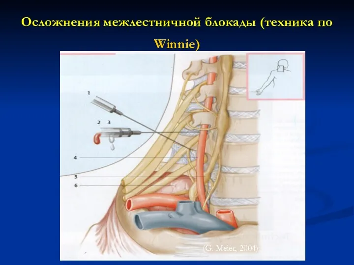 Осложнения межлестничной блокады (техника по Winnie) (G. Meier, 2004)