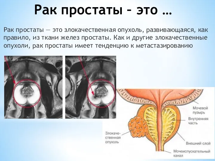 Рак простаты – это … Рак простаты — это злокачественная