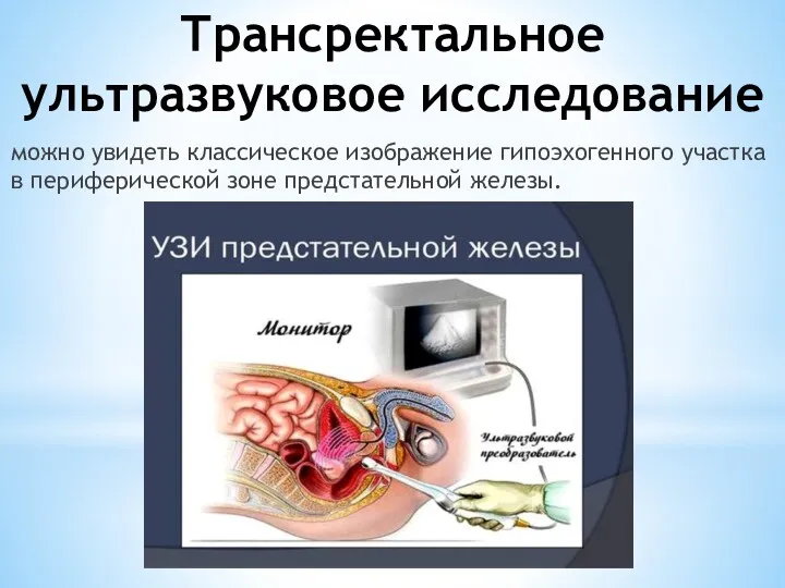 Трансректальное ультразвуковое исследование можно увидеть классическое изображение гипоэхогенного участка в периферической зоне предстательной железы.