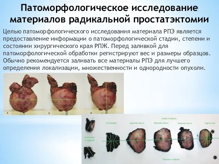 Патоморфологическое исследование материалов радикальной простатэктомии Целью патоморфологического исследования материала РПЭ