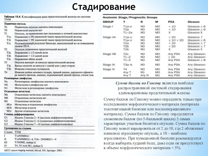 Стадирование Сумма баллов по Глисону является наиболее распространенной системой стадирования аденокарциномы предстательной железы.