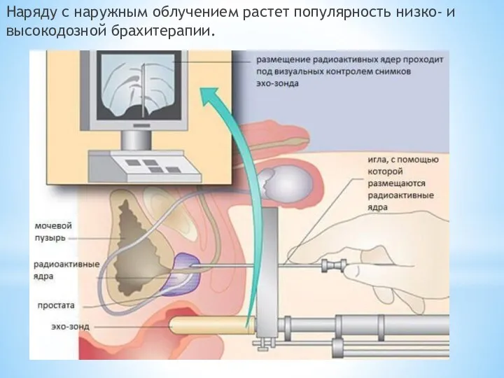 Наряду с наружным облучением растет популярность низко- и высокодозной брахитерапии.