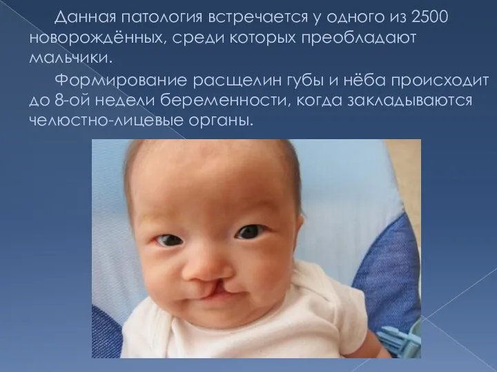 Данная патология встречается у одного из 2500 новорождённых, среди которых