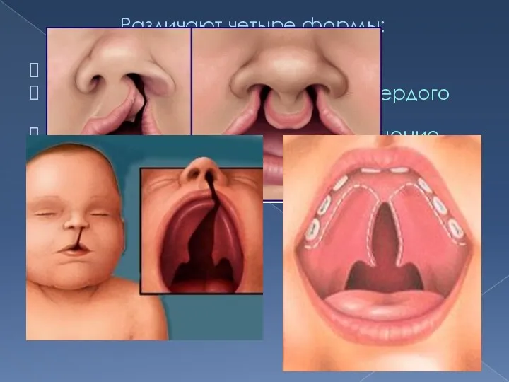Различают четыре формы: незаращение мягкого нёба, незаращение мягкого и части