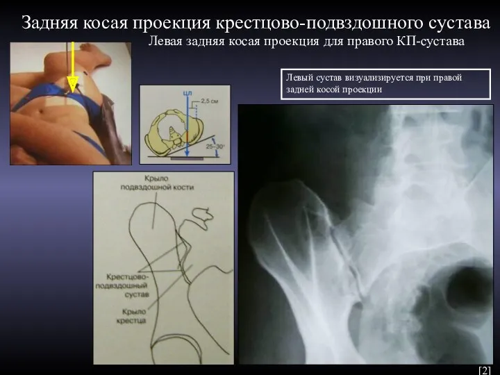 Левая задняя косая проекция для правого КП-сустава Задняя косая проекция