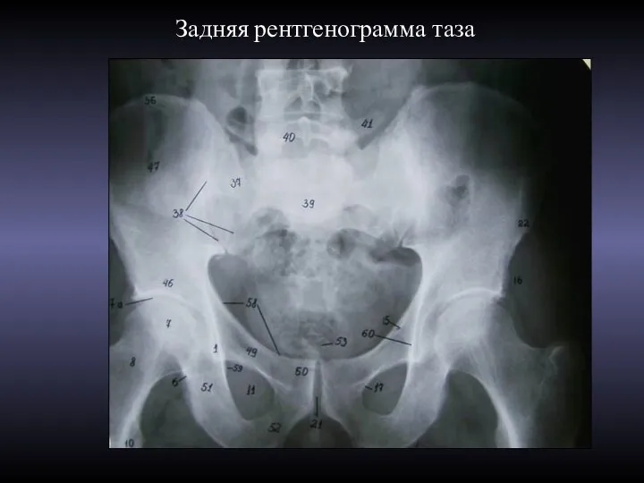 Задняя рентгенограмма таза
